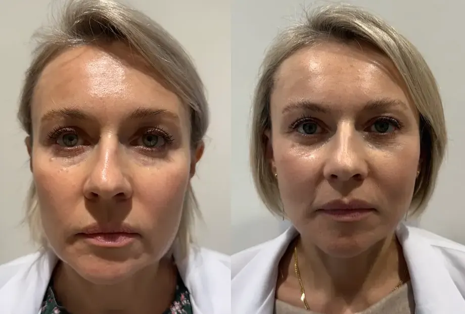 Deep Plane Facelift — глубокая подтяжка лица