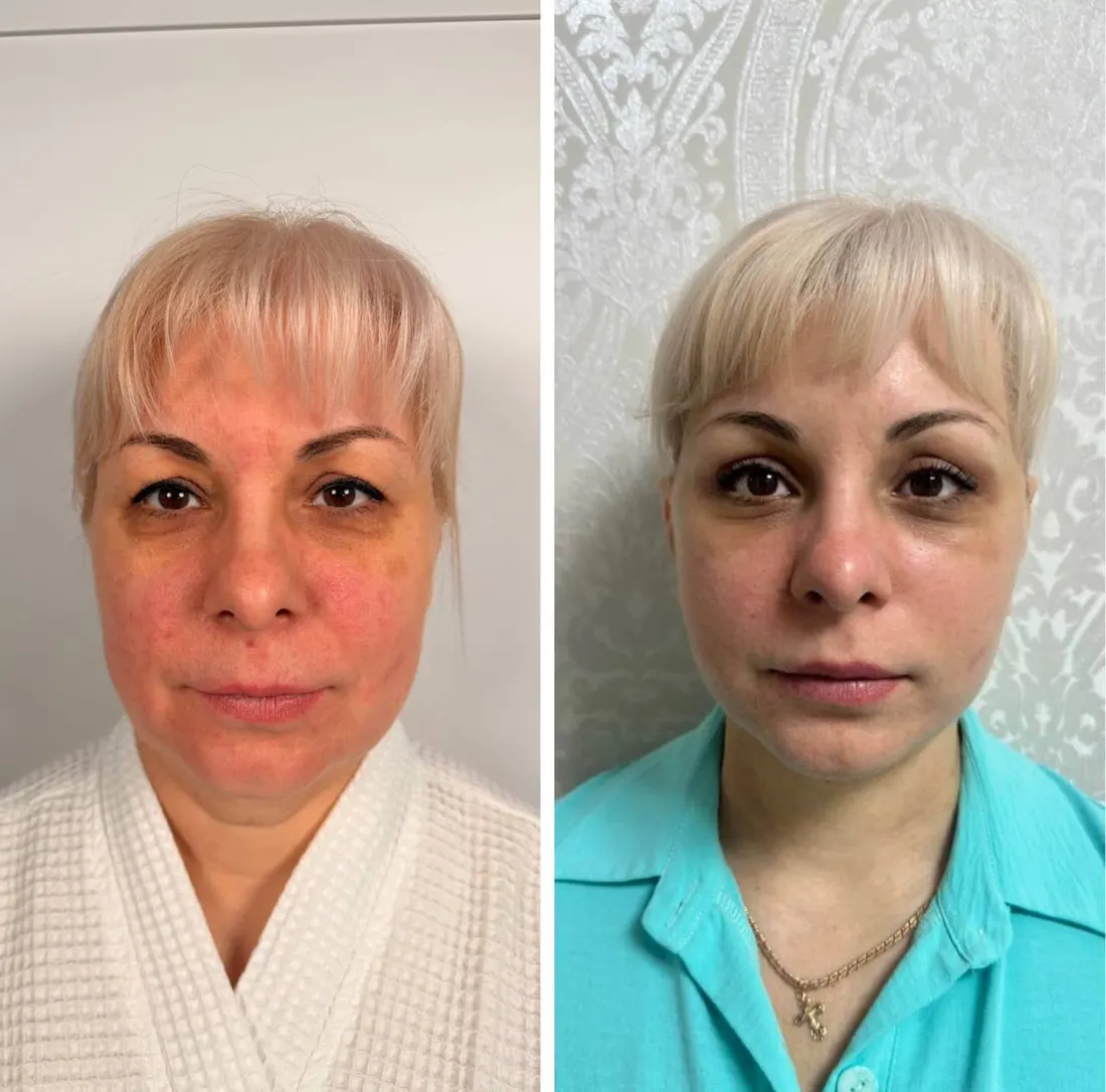 До и после: Full Face — комплексное омоложение