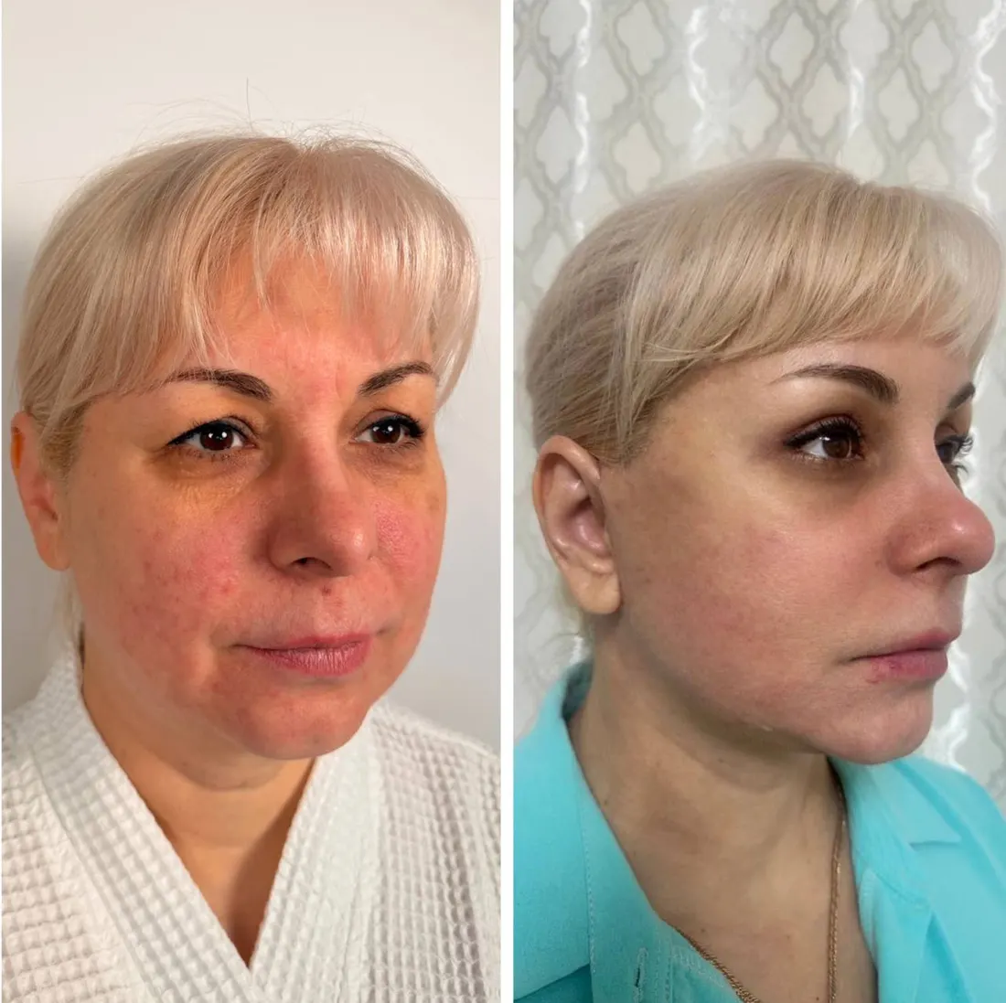 До и после: Full Face — комплексное омоложение